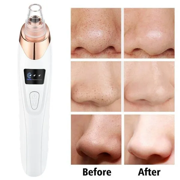 Premium Electric Blackhead Remover Vacuum | Face Vacuum Pore Cleanser-5 Suction Probes